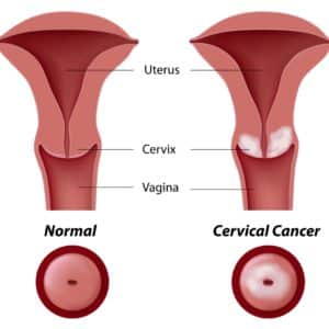 Rakovina krcka maternice